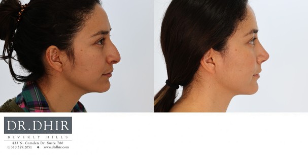 25 yr old Hispanic Female with nasal hump, under-rotated, droopy tip and mild columellar show.  The tip was refined, rotated and the nasal hump was removed.  A septoplasty was performed for breathing and straightening the nose.