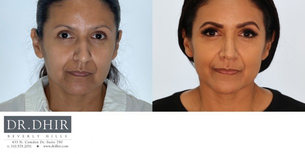 32 yr old Hispanic Female presents with moderately crooked nasal septum, bulbous tip, nasal hump, under-rotated nasal tip.  A rhinoplasty was performed to straighten the nose, refine the nasal tip with rotation and deprojection.  The nostrils were narrowed with alar wedge excision.