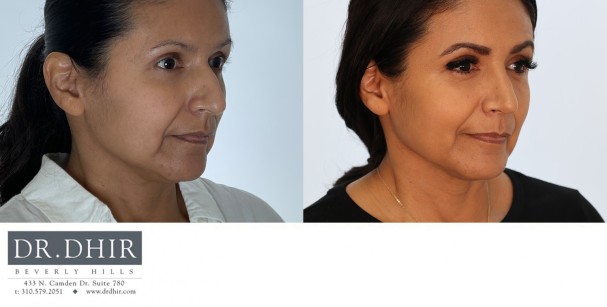 32 yr old Hispanic Female presents with moderately crooked nasal septum, bulbous tip, nasal hump, under-rotated nasal tip.  A rhinoplasty was performed to straighten the nose, refine the nasal tip with rotation and deprojection.  The nostrils were narrowed with alar wedge excision.