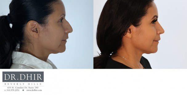 32 yr old Hispanic Female presents with moderately crooked nasal septum, bulbous tip, nasal hump, under-rotated nasal tip.  A rhinoplasty was performed to straighten the nose, refine the nasal tip with rotation and deprojection.  The nostrils were narrowed with alar wedge excision.