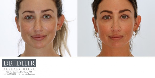 34 yr old female with nasal hump, bulbous tip and crooked septum.  An open rhinoplasty was performed with nasal hump removal, septal straightening with cartilage grafts, refinement of nasal tip with rotation and columellar support.