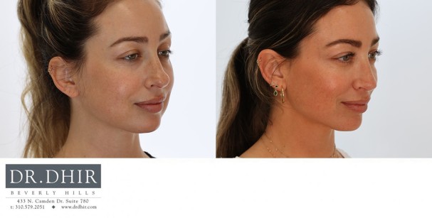 34 yr old female with nasal hump, bulbous tip and crooked septum.  An open rhinoplasty was performed with nasal hump removal, septal straightening with cartilage grafts, refinement of nasal tip with rotation and columellar support.