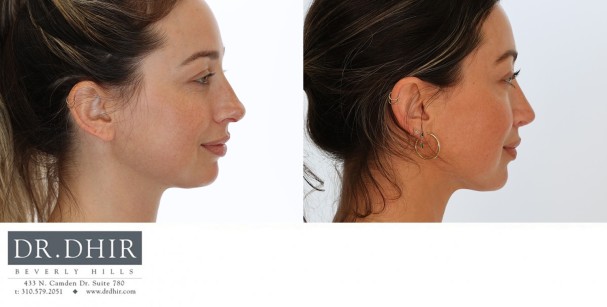 34 yr old female with nasal hump, bulbous tip and crooked septum.  An open rhinoplasty was performed with nasal hump removal, septal straightening with cartilage grafts, refinement of nasal tip with rotation and columellar support.