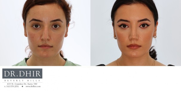 18 year old teenage rhinoplasty with nasal hump removal, septum straightening with cartilage grafting, tip support, refinement and rotation.