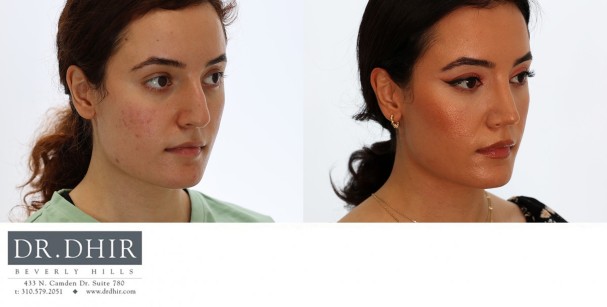 18 year old teenage rhinoplasty with nasal hump removal, septum straightening with cartilage grafting, tip support, refinement and rotation.