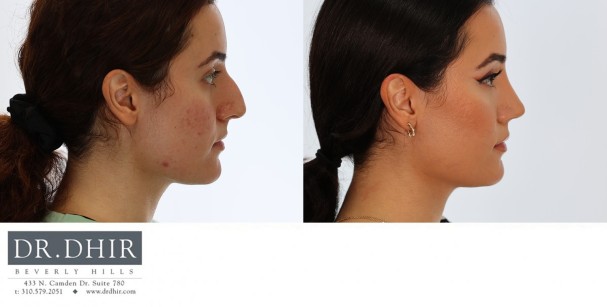 18 year old teenage rhinoplasty with nasal hump removal, septum straightening with cartilage grafting, tip support, refinement and rotation.