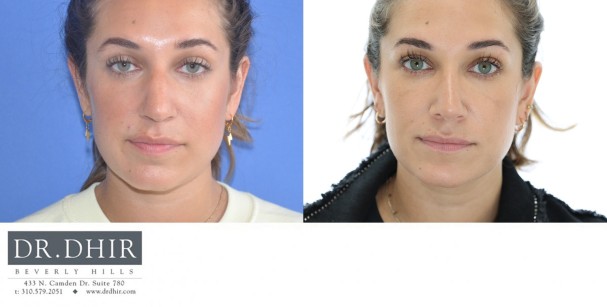 33 yr old ethnic female presents with nasal hump, crooked nasal septum, over-projected and under-rotated nasal tip.  She underwent rhinoplasty with tip refinement with rotation and deprojection, nasal hump removal, and septal straightening with cartilage grafts.