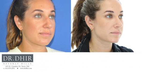 33 yr old ethnic female presents with nasal hump, crooked nasal septum, over-projected and under-rotated nasal tip.  She underwent rhinoplasty with tip refinement with rotation and deprojection, nasal hump removal, and septal straightening with cartilage grafts.