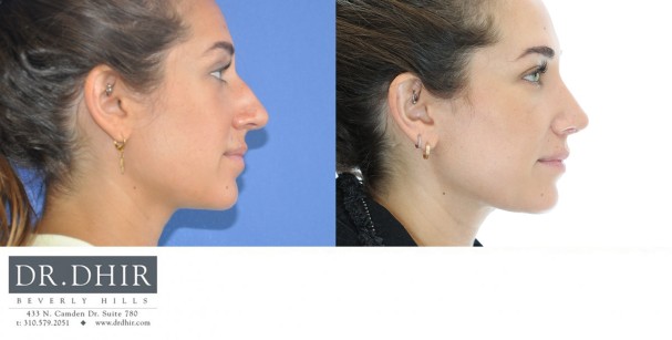 33 yr old ethnic female presents with nasal hump, crooked nasal septum, over-projected and under-rotated nasal tip.  She underwent rhinoplasty with tip refinement with rotation and deprojection, nasal hump removal, and septal straightening with cartilage grafts.