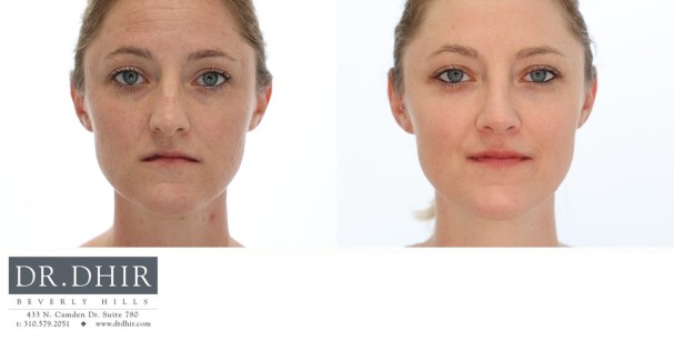 37 yr old Female presents with nasal hump, over projected and under rotated nasal tip.  Rhinoplasty was performed with nasal hump removal and tip refinement with deprojection and rotation.  The septum was straightened with internal spreader cartilage grafts, and nostril reduction with alar wedge resection.