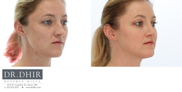 37 yr old Female presents with nasal hump, over projected and under rotated nasal tip.  Rhinoplasty was performed with nasal hump removal and tip refinement with deprojection and rotation.  The septum was straightened with internal spreader cartilage grafts, and nostril reduction with alar wedge resection.