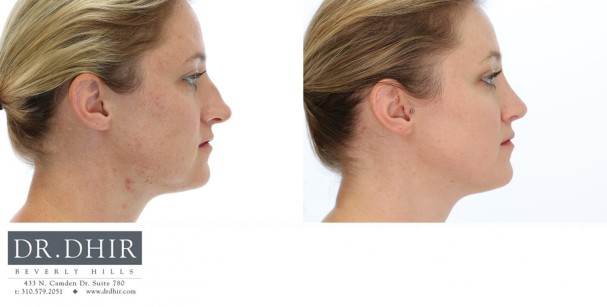 37 yr old Female presents with nasal hump, over projected and under rotated nasal tip.  Rhinoplasty was performed with nasal hump removal and tip refinement with deprojection and rotation.  The septum was straightened with internal spreader cartilage grafts, and nostril reduction with alar wedge resection.