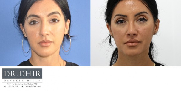 32 year old Hispanic female presents with nasal hump, crooked nasal septum, bulbous and unrefined nasal tip.  She underwent finesse rhinoplasty with nasal hump removal and refinement of nasal tip.  The septum was straightened for improved breathing and form.