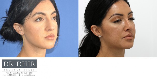 32 year old Hispanic female presents with nasal hump, crooked nasal septum, bulbous and unrefined nasal tip.  She underwent finesse rhinoplasty with nasal hump removal and refinement of nasal tip.  The septum was straightened for improved breathing and form.