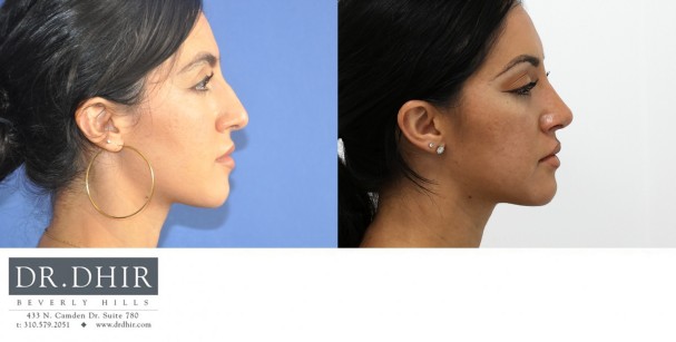 32 year old Hispanic female presents with nasal hump, crooked nasal septum, bulbous and unrefined nasal tip.  She underwent finesse rhinoplasty with nasal hump removal and refinement of nasal tip.  The septum was straightened for improved breathing and form.