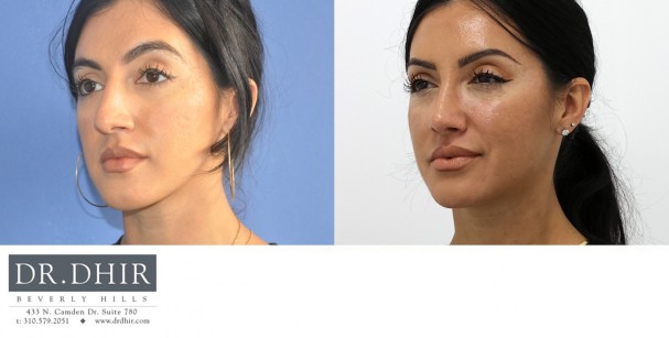 32 year old Hispanic female presents with nasal hump, crooked nasal septum, bulbous and unrefined nasal tip.  She underwent finesse rhinoplasty with nasal hump removal and refinement of nasal tip.  The septum was straightened for improved breathing and form.