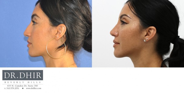 32 year old Hispanic female presents with nasal hump, crooked nasal septum, bulbous and unrefined nasal tip.  She underwent finesse rhinoplasty with nasal hump removal and refinement of nasal tip.  The septum was straightened for improved breathing and form.