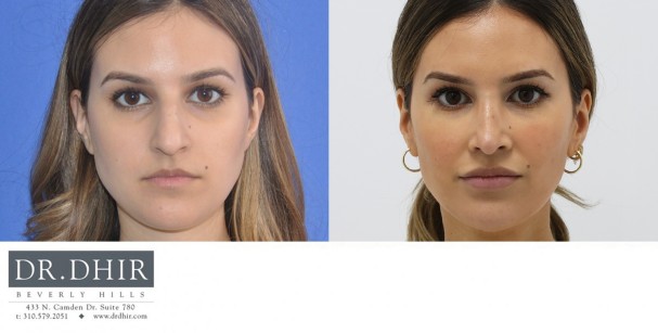 30 year Middle Eastern Female with wide nasal bones, nasal hump, deviated nasal septum and poorly supported nasal tip underwent open rhinoplasty.  The hump was removed and the nasal tip was supported to provide a balanced profile.