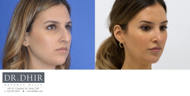 30 year Middle Eastern Female with wide nasal bones, nasal hump, deviated nasal septum and poorly supported nasal tip underwent open rhinoplasty.  The hump was removed and the nasal tip was supported to provide a balanced profile.