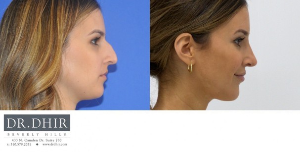 30 year Middle Eastern Female with wide nasal bones, nasal hump, deviated nasal septum and poorly supported nasal tip underwent open rhinoplasty.  The hump was removed and the nasal tip was supported to provide a balanced profile.