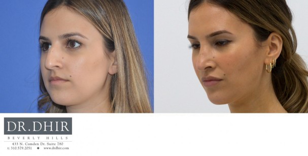 30 year Middle Eastern Female with wide nasal bones, nasal hump, deviated nasal septum and poorly supported nasal tip underwent open rhinoplasty.  The hump was removed and the nasal tip was supported to provide a balanced profile.