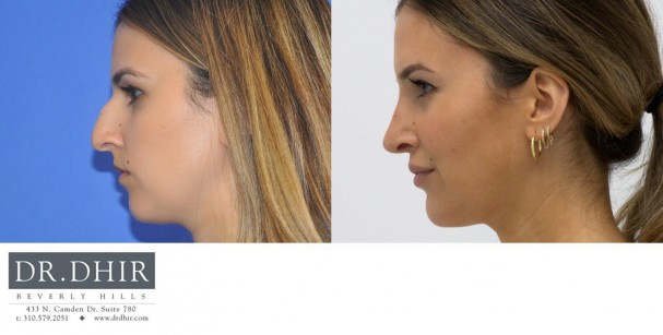 30 year Middle Eastern Female with wide nasal bones, nasal hump, deviated nasal septum and poorly supported nasal tip underwent open rhinoplasty.  The hump was removed and the nasal tip was supported to provide a balanced profile.