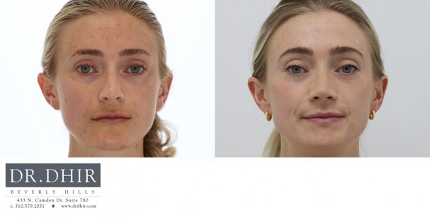 32 year Female with nasal hump, over-projected and unsupported nasal tip underwent open rhinoplasty.  The nasal bridge was contoured with nasal hump removal, and the tip was deprojected and rotated elegantly.  The nasal width was narrowed with alar wedge resection.