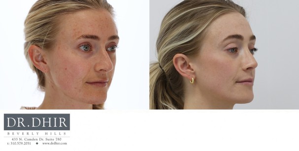 32 year Female with nasal hump, over-projected and unsupported nasal tip underwent open rhinoplasty.  The nasal bridge was contoured with nasal hump removal, and the tip was deprojected and rotated elegantly.  The nasal width was narrowed with alar wedge resection.