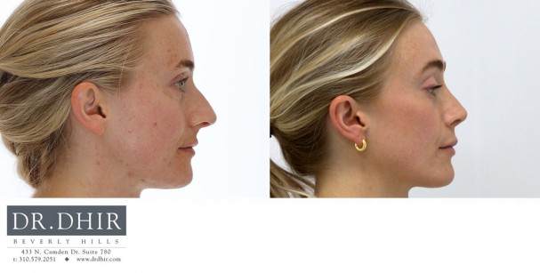 32 year Female with nasal hump, over-projected and unsupported nasal tip underwent open rhinoplasty.  The nasal bridge was contoured with nasal hump removal, and the tip was deprojected and rotated elegantly.  The nasal width was narrowed with alar wedge resection.
