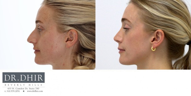 32 year Female with nasal hump, over-projected and unsupported nasal tip underwent open rhinoplasty.  The nasal bridge was contoured with nasal hump removal, and the tip was deprojected and rotated elegantly.  The nasal width was narrowed with alar wedge resection.