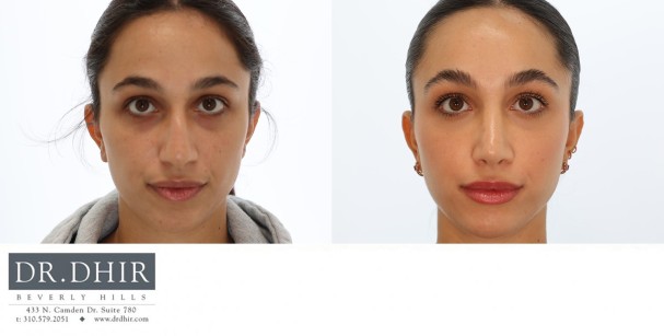 25 year old Middle Eastern Female with wide nasal bones, nasal hump with an unsupported and under projected nasal tip.  She underwent open rhinoplasty with nasal hump removal, nasal tip refinement and projection.