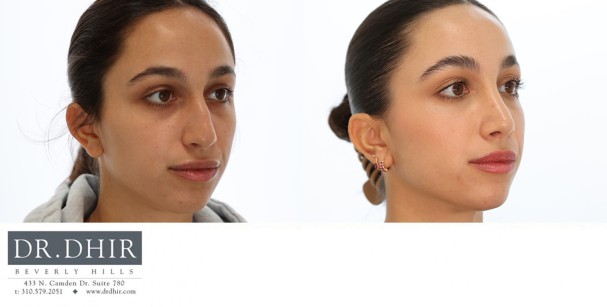 25 year old Middle Eastern Female with wide nasal bones, nasal hump with an unsupported and under projected nasal tip.  She underwent open rhinoplasty with nasal hump removal, nasal tip refinement and projection.
