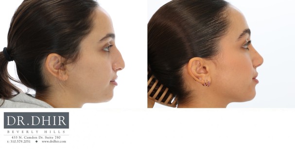 25 year old Middle Eastern Female with wide nasal bones, nasal hump with an unsupported and under projected nasal tip.  She underwent open rhinoplasty with nasal hump removal, nasal tip refinement and projection.