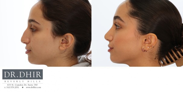 25 year old Middle Eastern Female with wide nasal bones, nasal hump with an unsupported and under projected nasal tip.  She underwent open rhinoplasty with nasal hump removal, nasal tip refinement and projection.