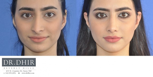 29 year old Middle Eastern Female presents with nasal hump, droopy nasal tip with columellar hang and crooked nasal septum.  Open rhinoplasty was performed and the nasal hump was removed, the deviated septum was straightened and the tip was supported with cartilage grafts.