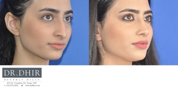 29 year old Middle Eastern Female presents with nasal hump, droopy nasal tip with columellar hang and crooked nasal septum.  Open rhinoplasty was performed and the nasal hump was removed, the deviated septum was straightened and the tip was supported with cartilage grafts.