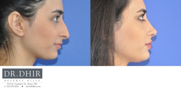 29 year old Middle Eastern Female presents with nasal hump, droopy nasal tip with columellar hang and crooked nasal septum.  Open rhinoplasty was performed and the nasal hump was removed, the deviated septum was straightened and the tip was supported with cartilage grafts.