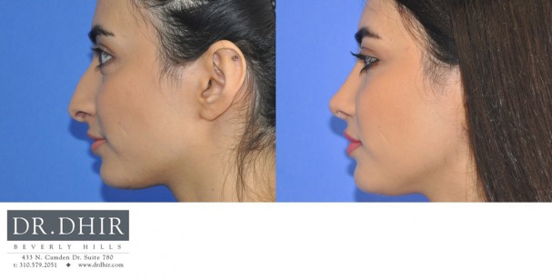 29 year old Middle Eastern Female presents with nasal hump, droopy nasal tip with columellar hang and crooked nasal septum.  Open rhinoplasty was performed and the nasal hump was removed, the deviated septum was straightened and the tip was supported with cartilage grafts.