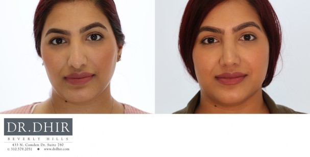 33 year old Ethnic Female with thick nasal skin presents with nasal hump, wide nasal bones and a poorly supported droopy nasal tip.  The septum was straightened, the hump was removed and tip was refined and supported with cartilage grafts.  The nostrils were narrowed with alar wedge resection