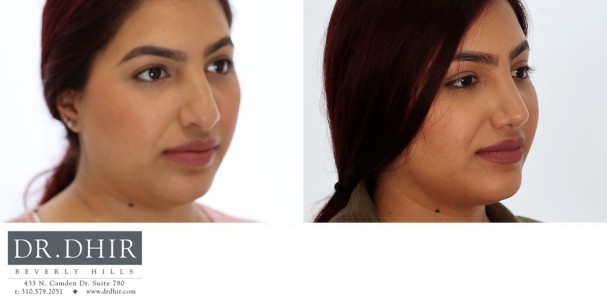 33 year old Ethnic Female with thick nasal skin presents with nasal hump, wide nasal bones and a poorly supported droopy nasal tip.  The septum was straightened, the hump was removed and tip was refined and supported with cartilage grafts.  The nostrils were narrowed with alar wedge resection
