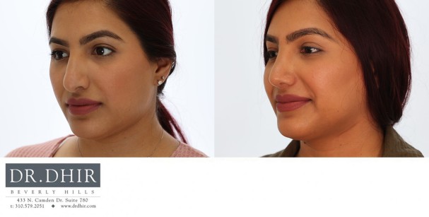 33 year old Ethnic Female with thick nasal skin presents with nasal hump, wide nasal bones and a poorly supported droopy nasal tip.  The septum was straightened, the hump was removed and tip was refined and supported with cartilage grafts.  The nostrils were narrowed with alar wedge resection