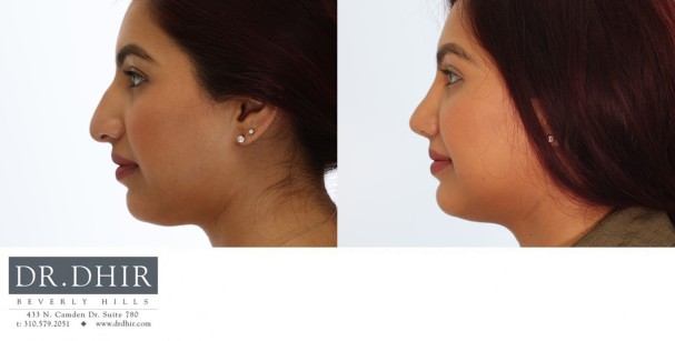 33 year old Ethnic Female with thick nasal skin presents with nasal hump, wide nasal bones and a poorly supported droopy nasal tip.  The septum was straightened, the hump was removed and tip was refined and supported with cartilage grafts.  The nostrils were narrowed with alar wedge resection