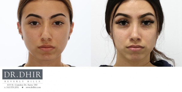 27 yr old Middle Eastern Female with nasal hump, wide nasal bones, crooked nasal septum and a bulbous unsupported tip.  The nasal hump was removed, the septum was corrected and the nasal tip was refined and supported with cartilage grafting.