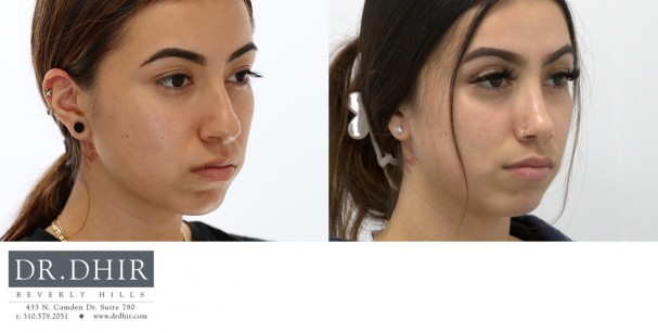 27 yr old Middle Eastern Female with nasal hump, wide nasal bones, crooked nasal septum and a bulbous unsupported tip.  The nasal hump was removed, the septum was corrected and the nasal tip was refined and supported with cartilage grafting.