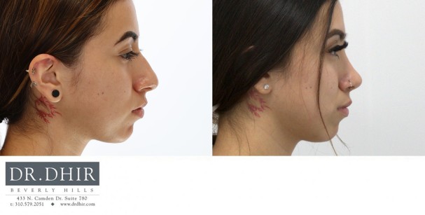27 yr old Middle Eastern Female with nasal hump, wide nasal bones, crooked nasal septum and a bulbous unsupported tip.  The nasal hump was removed, the septum was corrected and the nasal tip was refined and supported with cartilage grafting.