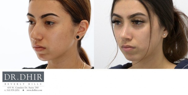 27 yr old Middle Eastern Female with nasal hump, wide nasal bones, crooked nasal septum and a bulbous unsupported tip.  The nasal hump was removed, the septum was corrected and the nasal tip was refined and supported with cartilage grafting.