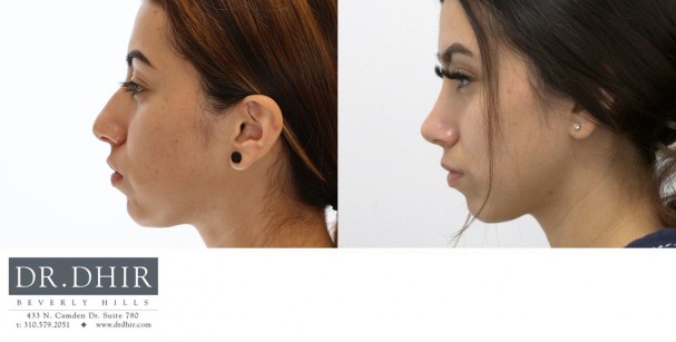 27 yr old Middle Eastern Female with nasal hump, wide nasal bones, crooked nasal septum and a bulbous unsupported tip.  The nasal hump was removed, the septum was corrected and the nasal tip was refined and supported with cartilage grafting.