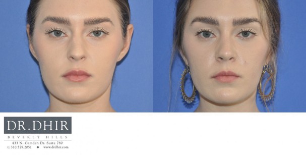 30 year old female with nasal hump, wide nasal bones and unrefined nasal tip underwent open finesse rhinoplasty.  The nasal hump was removed, the septum was straightened and the nasal tip was refined.