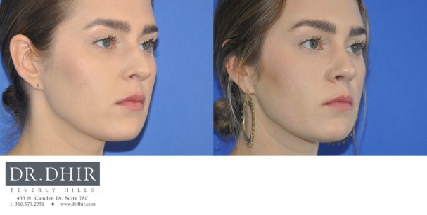 30 year old female with nasal hump, wide nasal bones and unrefined nasal tip underwent open finesse rhinoplasty.  The nasal hump was removed, the septum was straightened and the nasal tip was refined.