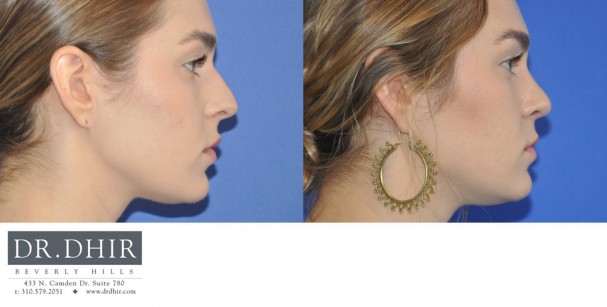 30 year old female with nasal hump, wide nasal bones and unrefined nasal tip underwent open finesse rhinoplasty.  The nasal hump was removed, the septum was straightened and the nasal tip was refined.